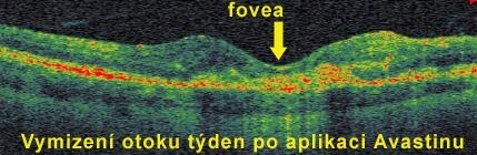 Průřez lidskou sítnicí získaný bezdotykovým vyšetřením přístrojem OCT/SLO
