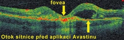 Průřez lidskou sítnicí získaný bezdotykovým vyšetřením přístrojem OCT/SLO