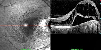 Fluorescenční angiografie u idiopatické epimakulární membrány
